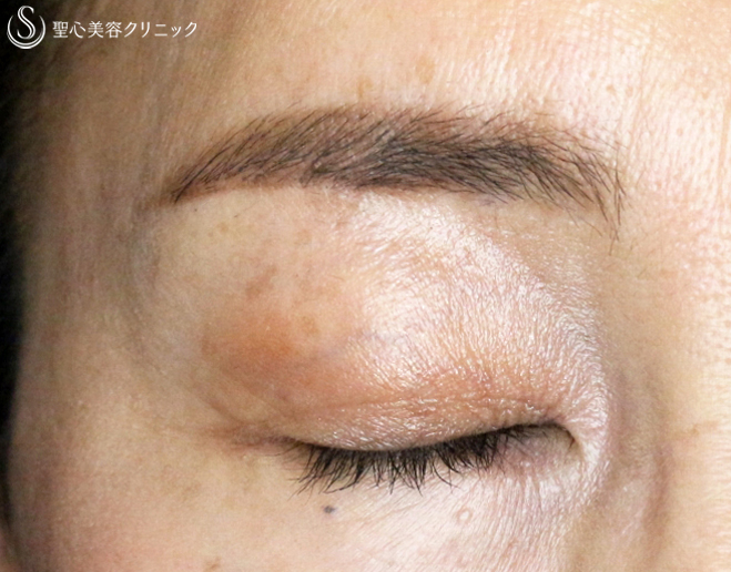 【40代女性・ハードコンタクトレンズ眼瞼下垂の長期経過】切らない眼瞼下垂+α法（9年後） After 