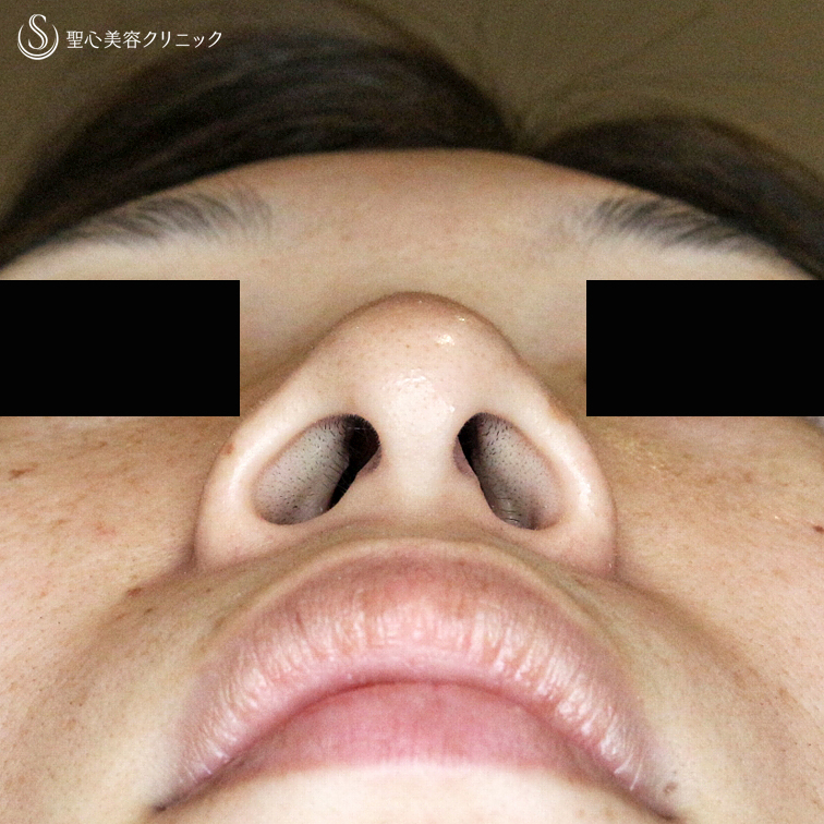 【30代女性・大きな小鼻で正面から鼻の穴が見える】小鼻縮小術+α法「Ver.5」（6ヶ月後） Before 