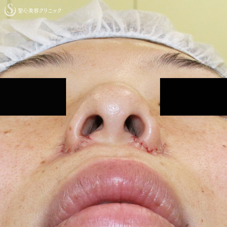【30代女性・大きな小鼻で正面から鼻の穴が見える】小鼻縮小術+α法「Ver.5」（6ヶ月後） Before 