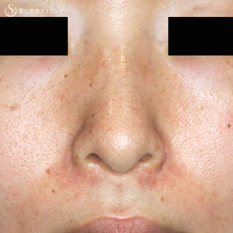 【30代女性・大きな小鼻で正面から鼻の穴が見える】小鼻縮小術+α法「Ver.5」（6ヶ月後） After 