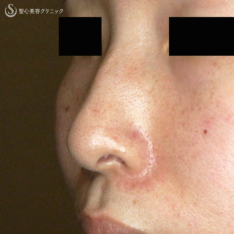 【30代女性・大きな小鼻で正面から鼻の穴が見える】小鼻縮小術+α法「Ver.5」（6ヶ月後） After 