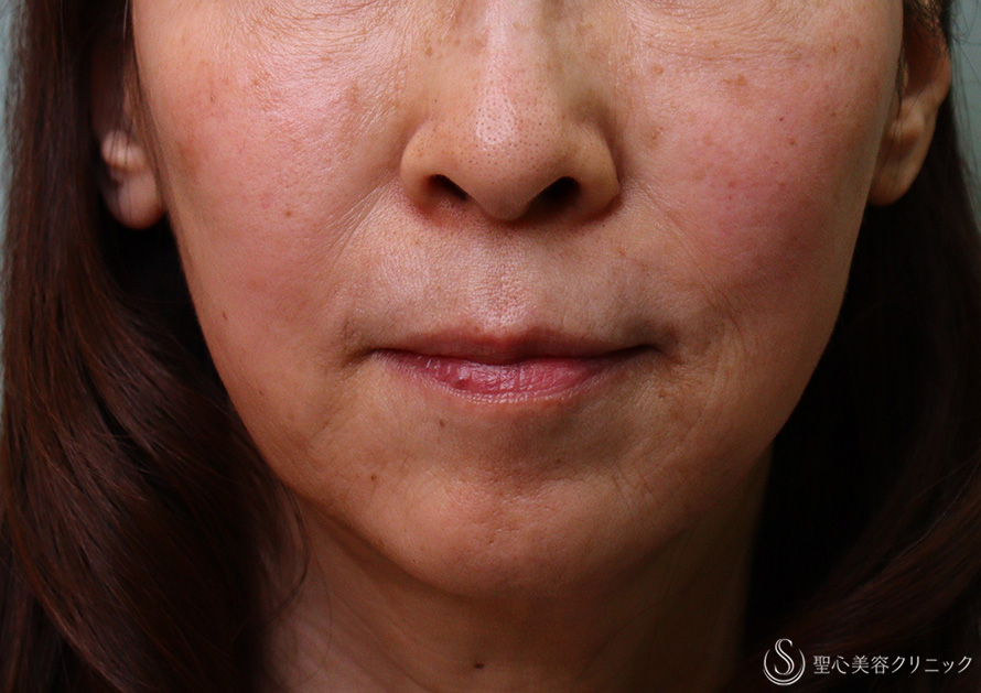 【60代女性・マリオネットラインのしわ】プレミアムPRP皮膚再生療法、ボトックス（4ヶ月後） After 
