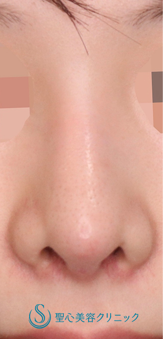 【20代女性・鼻の穴を目立ちにくくしたい！！】鼻孔縁下降術（術後1ヶ月） Before 