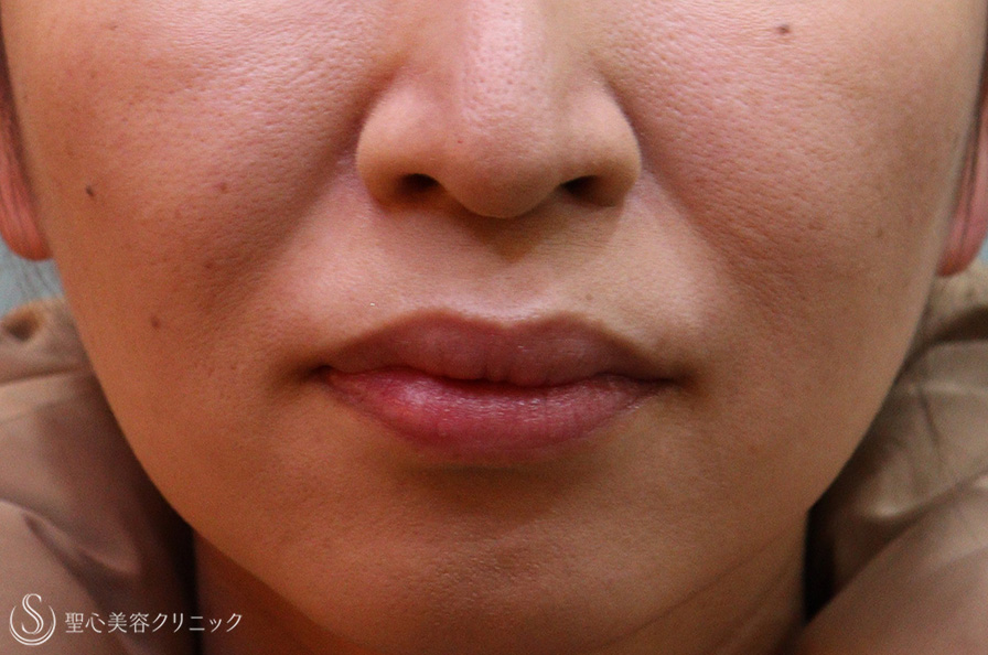 【40代女性・ほうれい線】プレミアムPRP皮膚再生療法（5ヶ月後） Before 