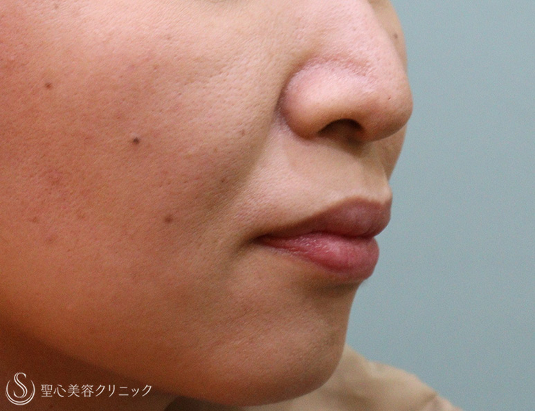 【40代女性・ほうれい線】プレミアムPRP皮膚再生療法（5ヶ月後） Before 