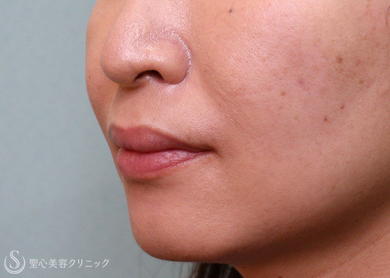 【40代女性・ほうれい線】プレミアムPRP皮膚再生療法（5ヶ月後） After 