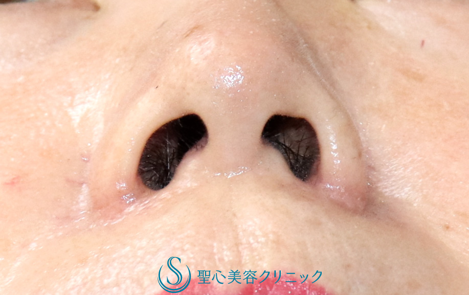 【60代女性・小鼻の丸み、鼻の穴の大きさを自然に改善したい】小鼻縮小（鼻翼縮小）（術後1ヶ月） After 