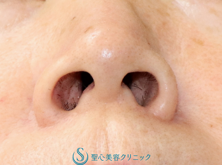 【60代女性・小鼻の丸み、鼻の穴の大きさを自然に改善したい】小鼻縮小（鼻翼縮小）（術後1ヶ月） Before 