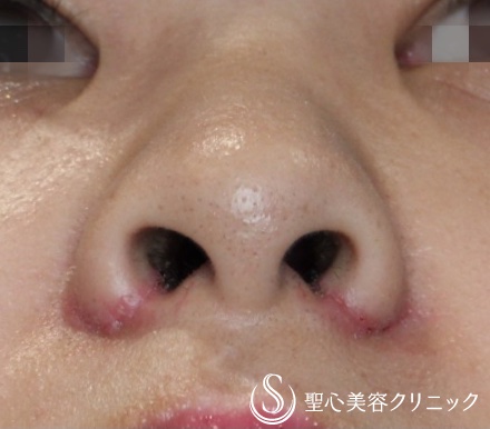【20代女性・正面から鼻の穴が見える】小鼻縮小術（抜糸直後(7日後)） After 