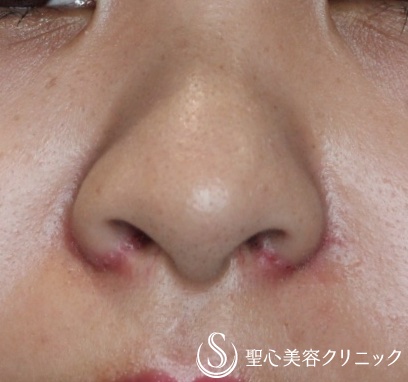 【20代女性・正面から鼻の穴が見える】小鼻縮小術（抜糸直後(7日後)） After 