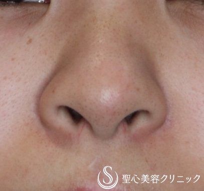 【20代女性・正面から鼻の穴が見える】小鼻縮小術（抜糸直後(7日後)） Before 