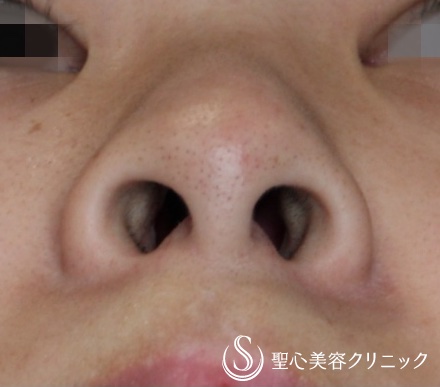 【20代女性・正面から鼻の穴が見える】小鼻縮小術（抜糸直後(7日後)） Before 