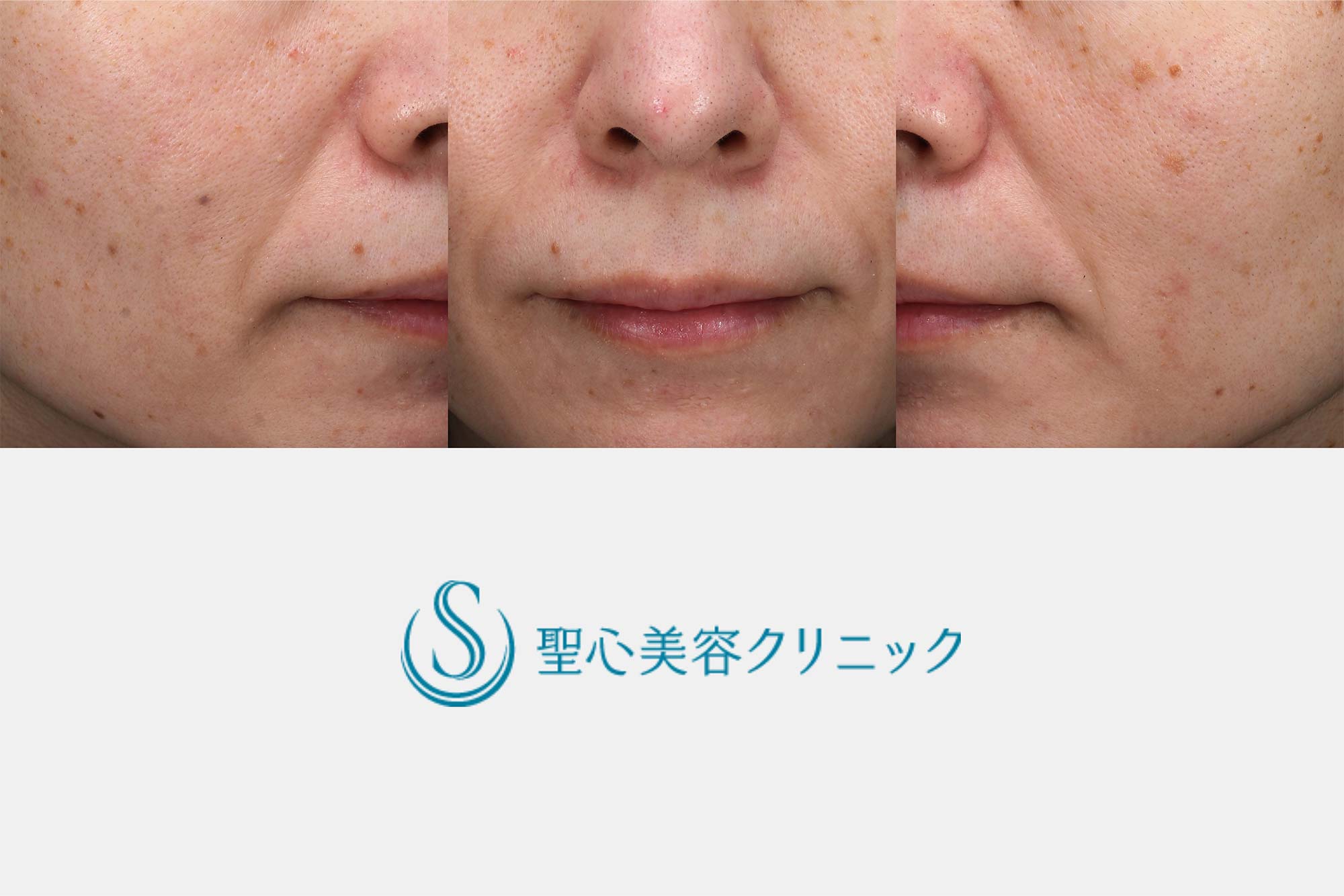 【40代女性・ほうれい線】プレミアムPRP皮膚再生療法（7ヶ月後） Before 