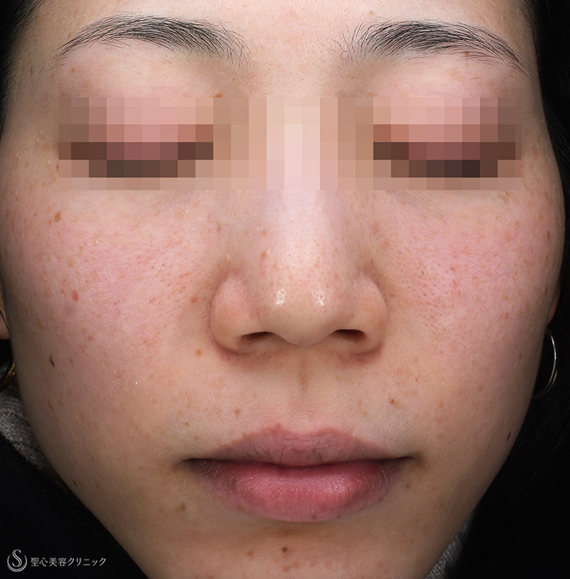 【30代女性・赤ら顔、色むら】セレックV（3回処置後1か月） Before 