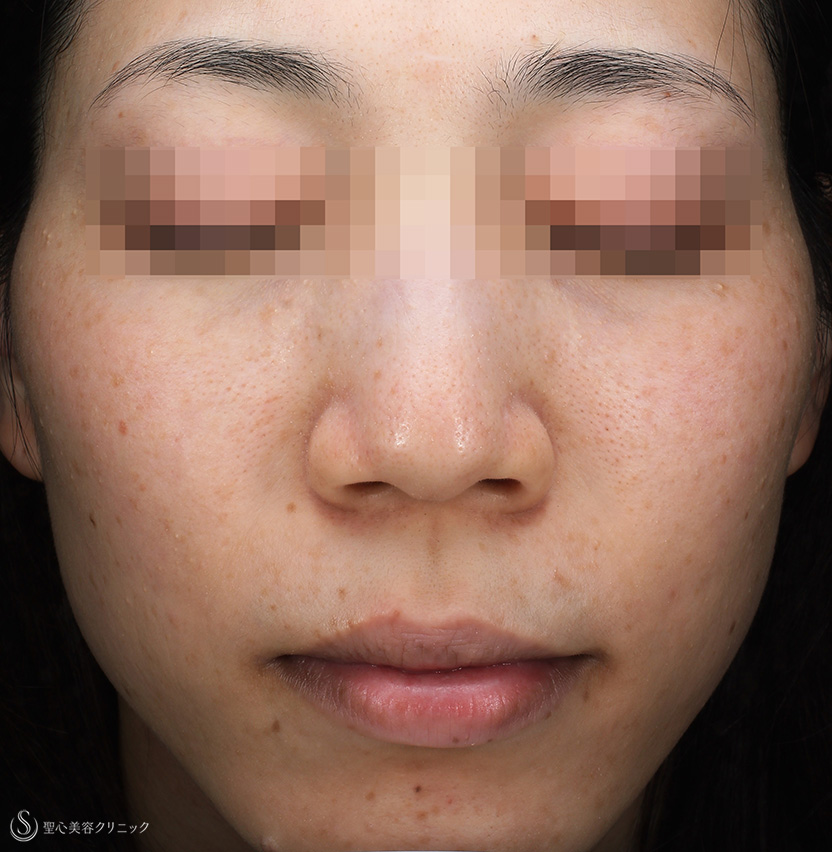 【30代女性・赤ら顔、色むら】セレックV（3回処置後1か月） After 