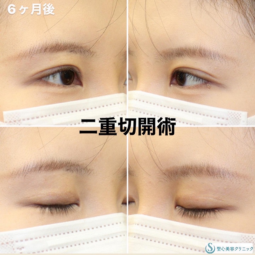 【20代女性・二重切開法でナチュラルに美しい二重を】二重術（切開法）部分切開/全切開（6ヶ月後） After 