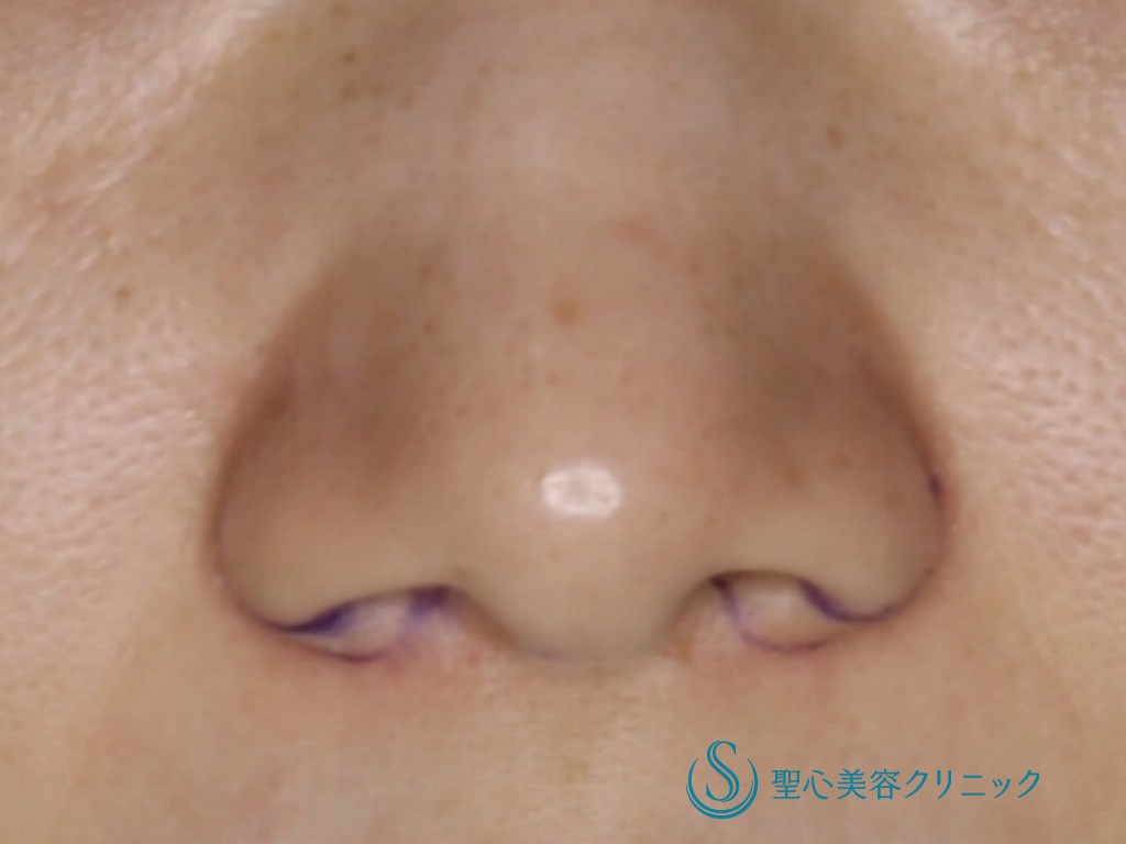 【30代女性・目立たない小鼻に】小鼻縮小（術後1ヶ月） Before 