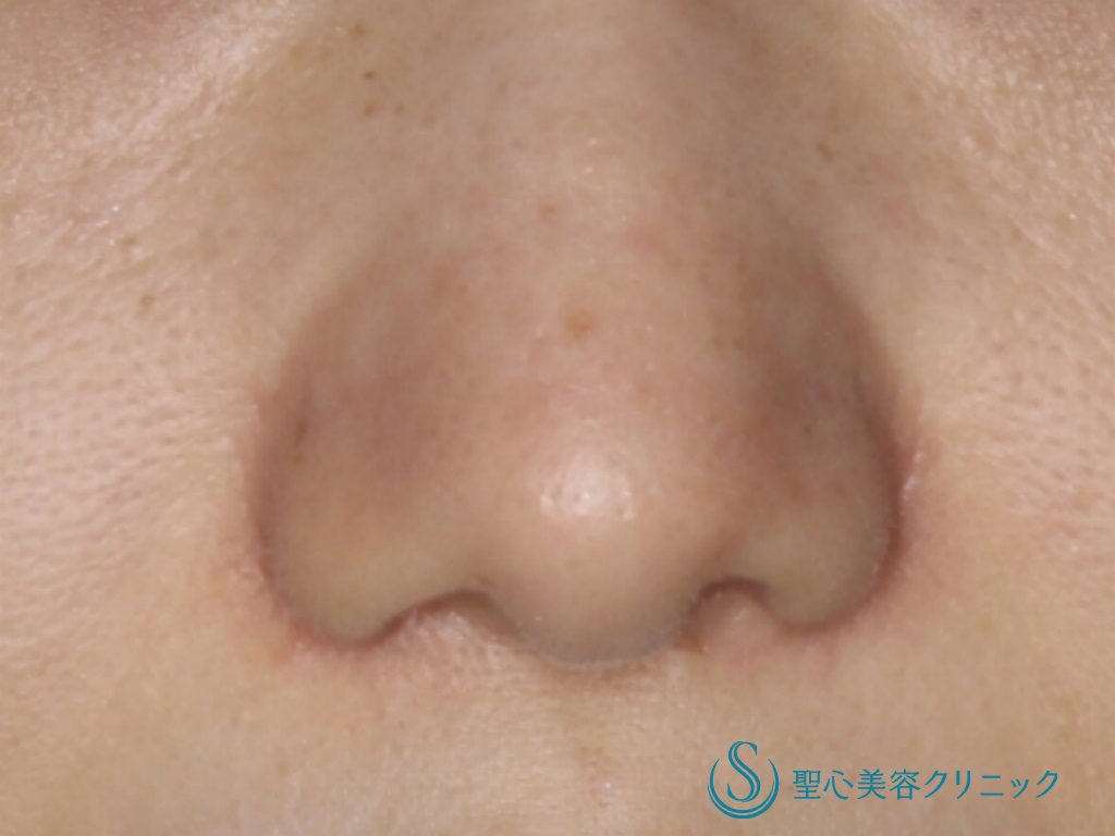 【30代女性・目立たない小鼻に】小鼻縮小（術後1ヶ月） After 