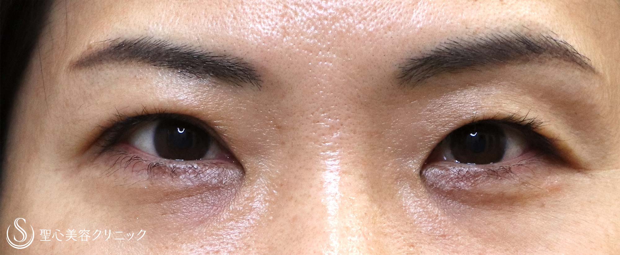 【40代女性・くぼみ目の改善】眼瞼下垂（1週間～1ヶ月後） After 