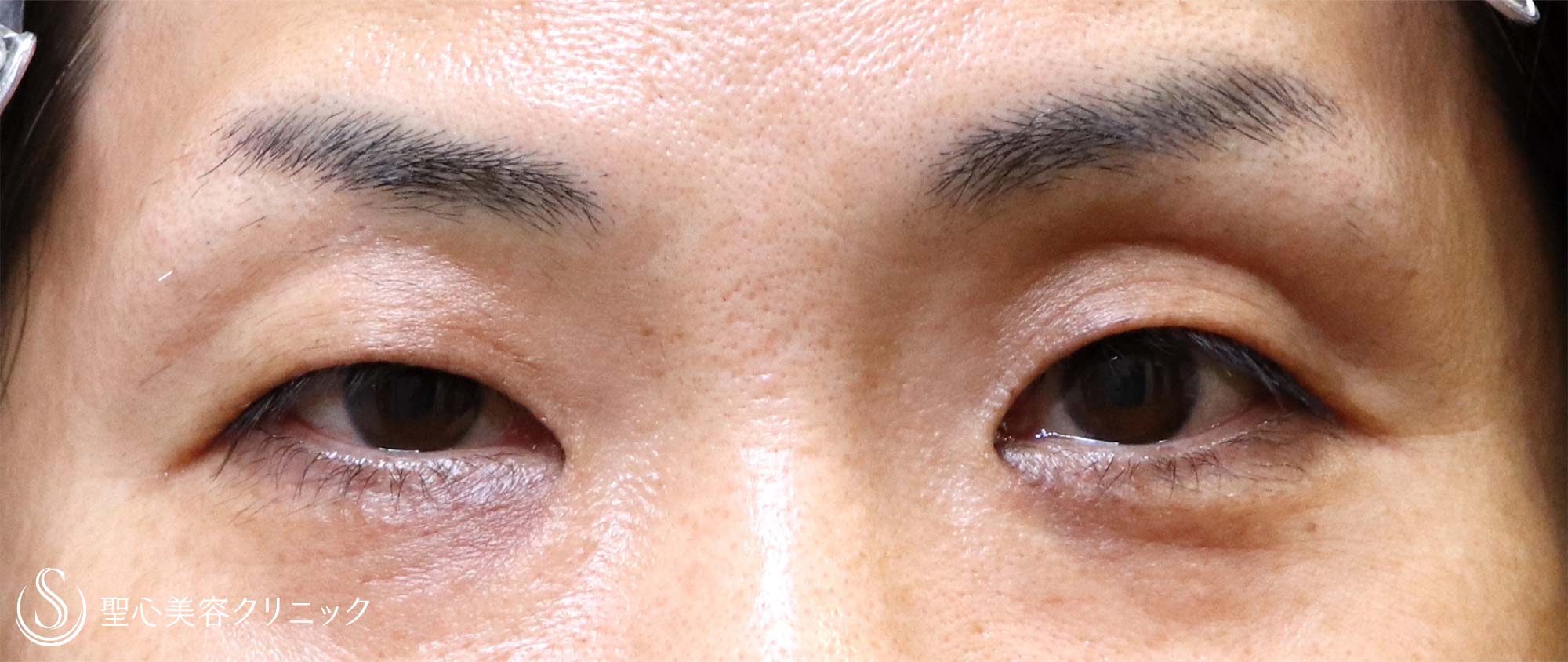 【40代女性・くぼみ目の改善】眼瞼下垂（1週間～1ヶ月後） Before 
