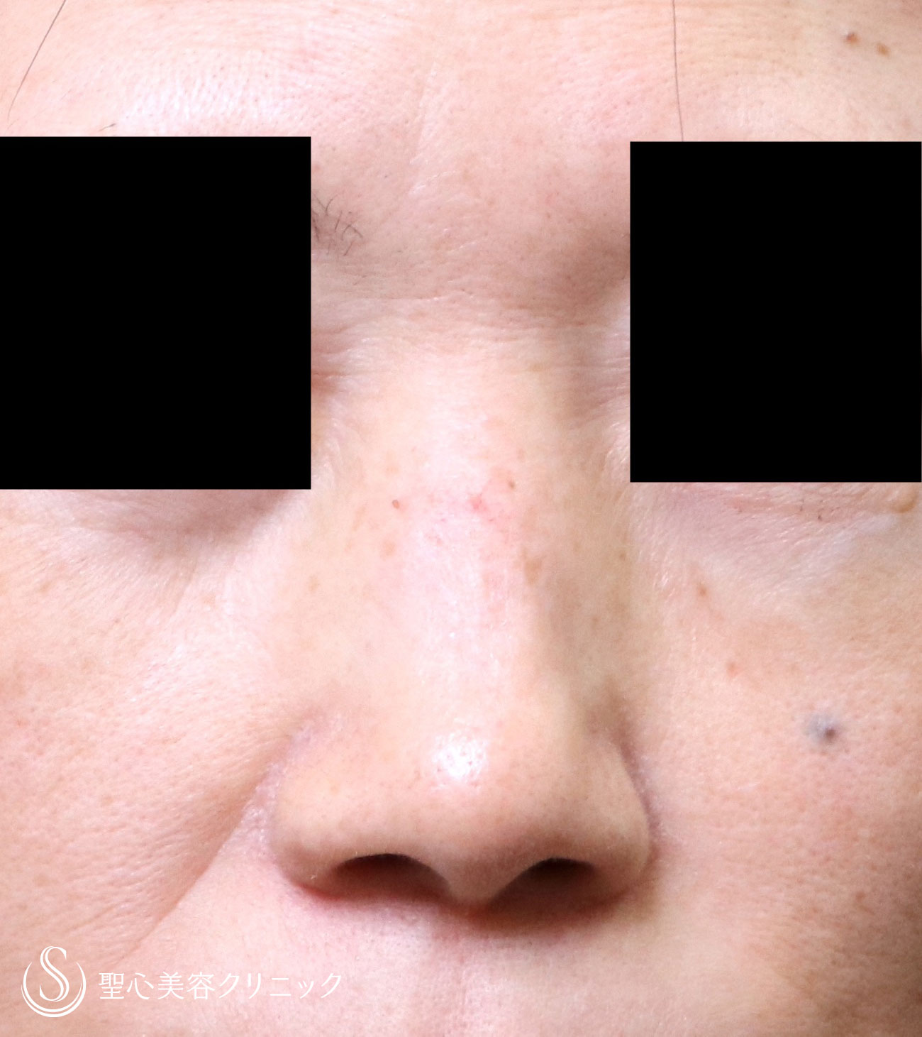 【50代女性・鼻をすっきりとしたラインに】鼻のプロテーゼ＋耳介軟骨（1週間後） Before 