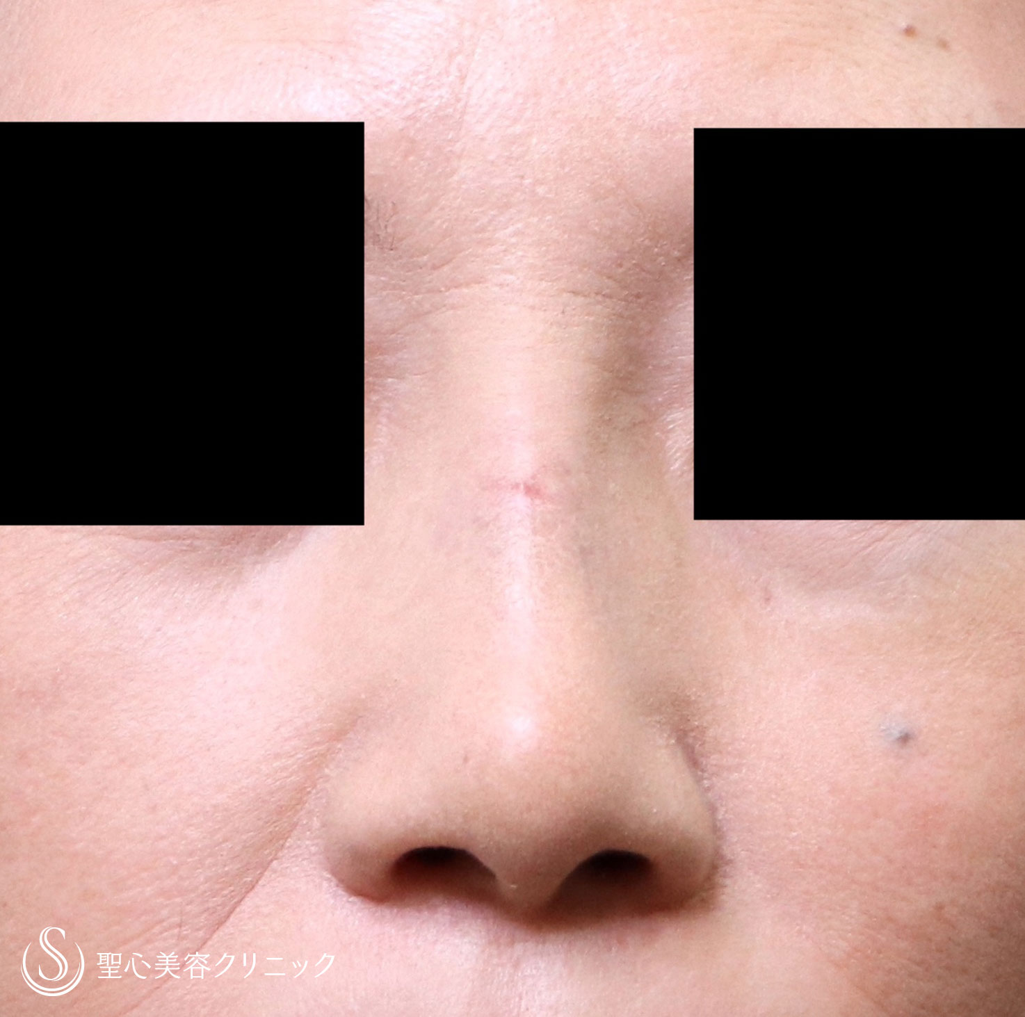 【50代女性・鼻をすっきりとしたラインに】鼻のプロテーゼ＋耳介軟骨（1週間後） After 