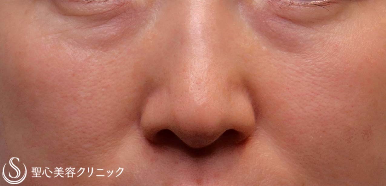 【50代女性・切らない目の下の若返り！！】プレミアムPRP皮膚再生療法（2ヶ月後） Before 