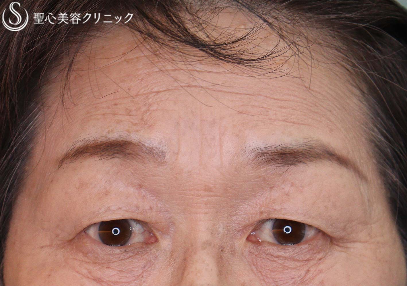 【60代女性・瞼のたるみ】眉下切開（1ヶ月後） Before 
