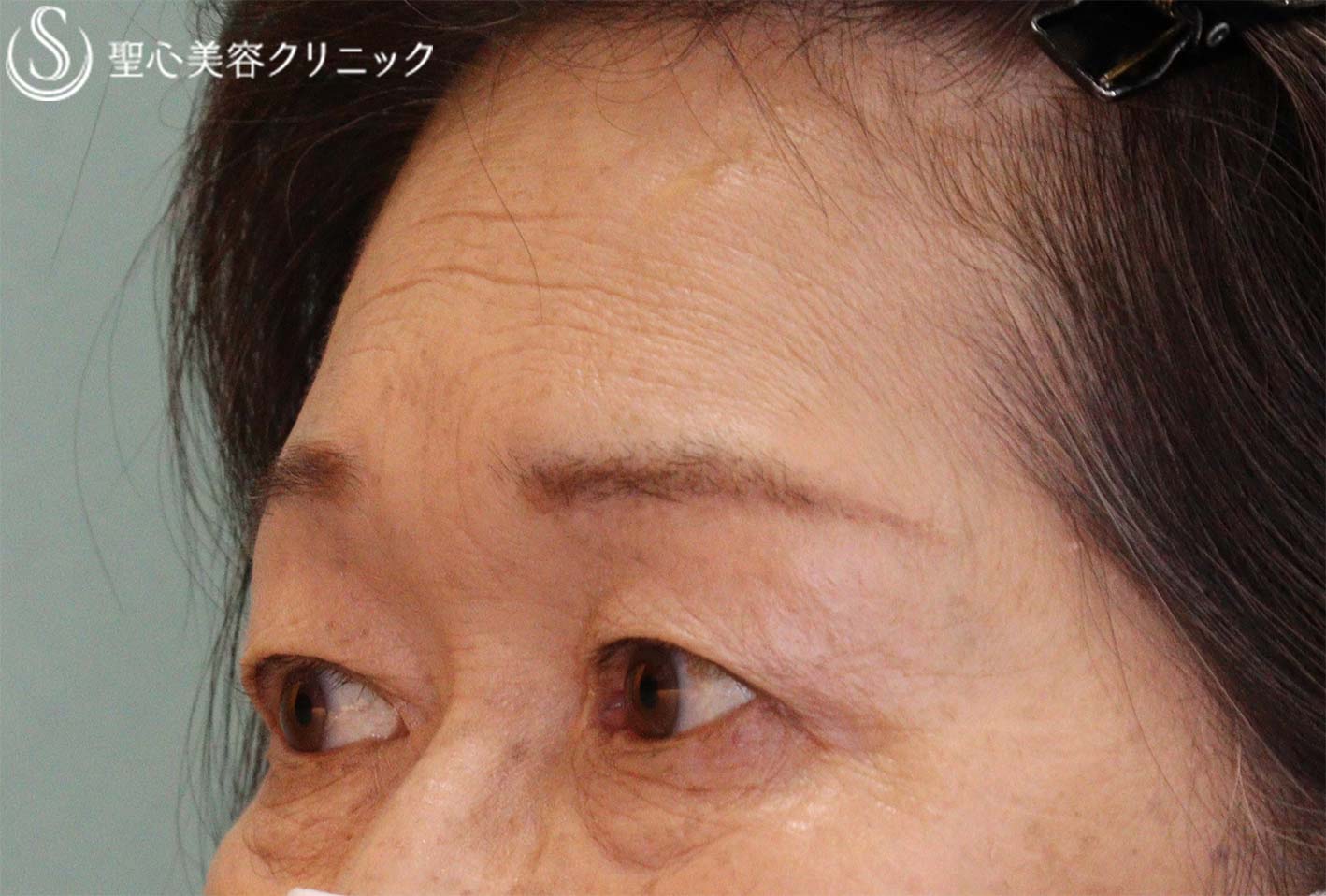 【60代女性・瞼のたるみ】眉下切開（1ヶ月後） After 