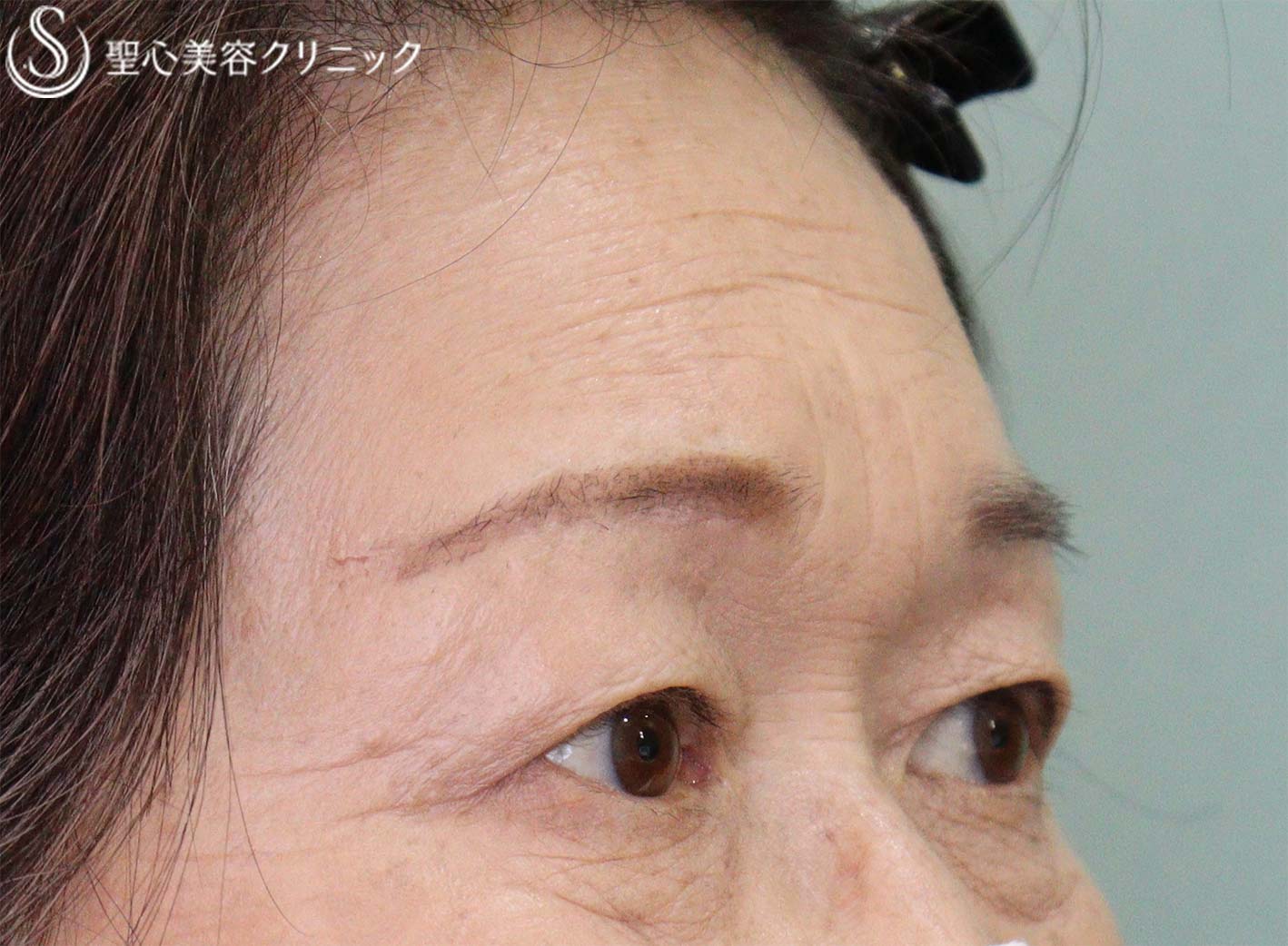 【60代女性・瞼のたるみ】眉下切開（1ヶ月後） After 