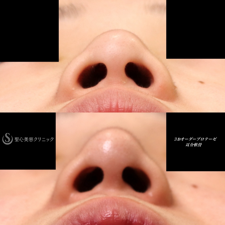 【10代女性・鼻筋をスッキリと】鼻３Dプロテーゼ＋耳介軟骨（1ヶ月後） After 
