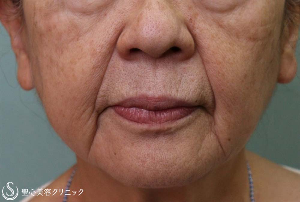 【70代女性・ほうれい線】プレミアムPRP皮膚再生療法（10ヶ月後） Before 