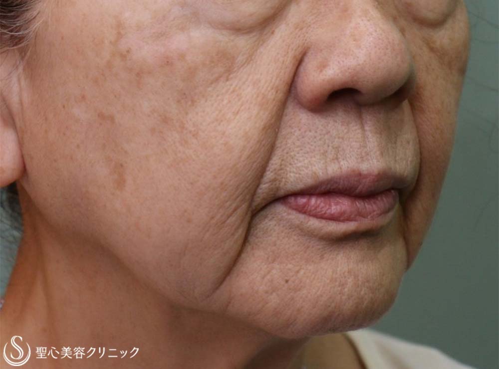 【70代女性・ほうれい線】プレミアムPRP皮膚再生療法（10ヶ月後） Before 