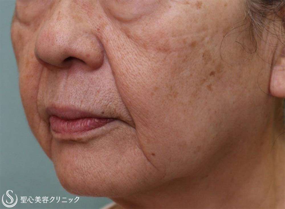 【70代女性・ほうれい線】プレミアムPRP皮膚再生療法（10ヶ月後） Before 