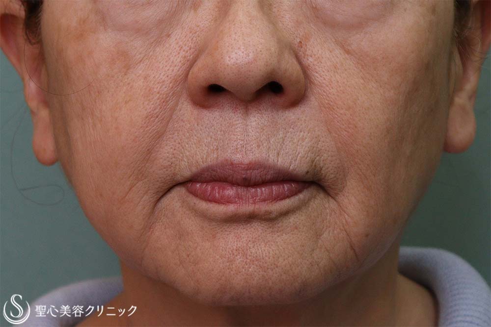 【70代女性・ほうれい線】プレミアムPRP皮膚再生療法（10ヶ月後） After 