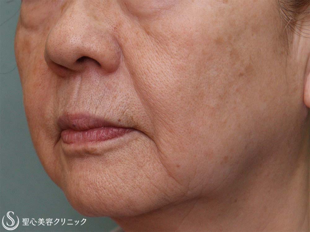 【70代女性・ほうれい線】プレミアムPRP皮膚再生療法（10ヶ月後） After 