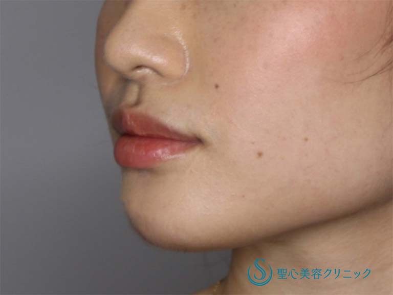 【20代女性・あごをシャープにしたい】あごのヒアルロン酸注入（直後） Before 