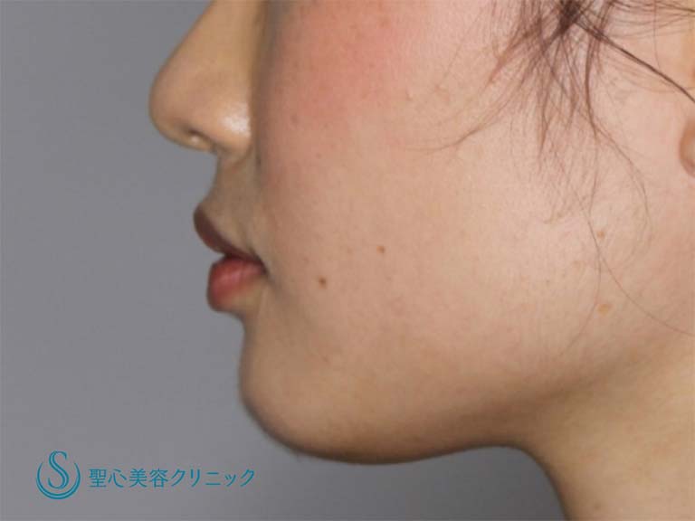【20代女性・あごをシャープにしたい】あごのヒアルロン酸注入（直後） Before 
