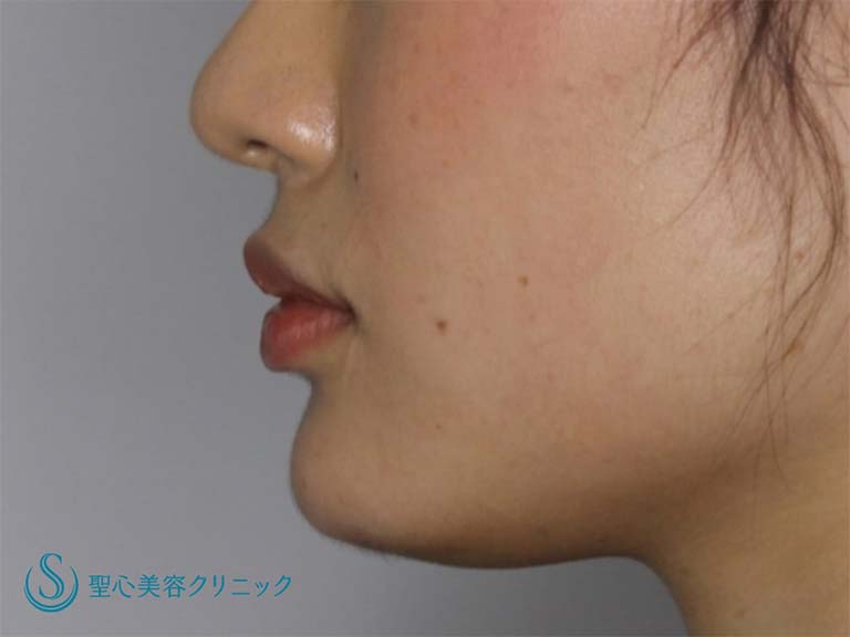 【20代女性・あごをシャープにしたい】あごのヒアルロン酸注入（直後） After 
