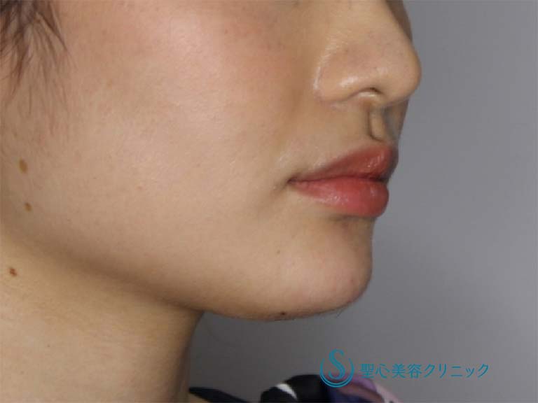 【20代女性・あごをシャープにしたい】あごのヒアルロン酸注入（直後） After 