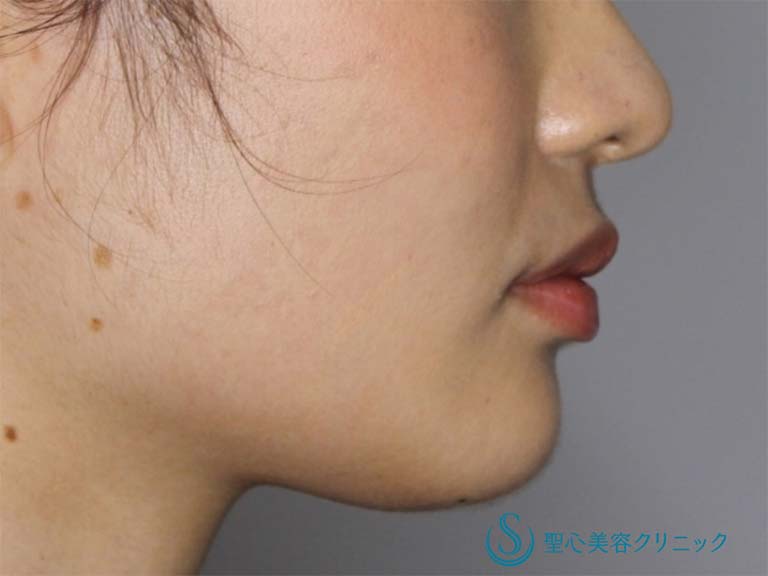【20代女性・あごをシャープにしたい】あごのヒアルロン酸注入（直後） Before 