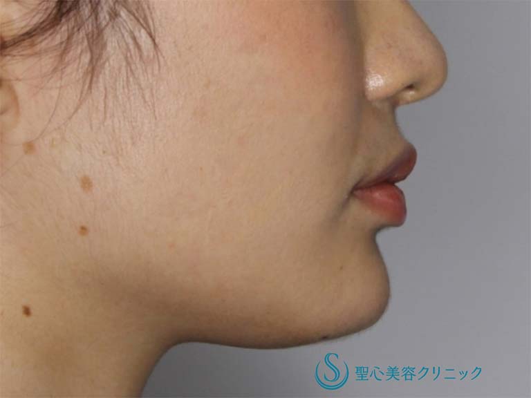 【20代女性・あごをシャープにしたい】あごのヒアルロン酸注入（直後） After 
