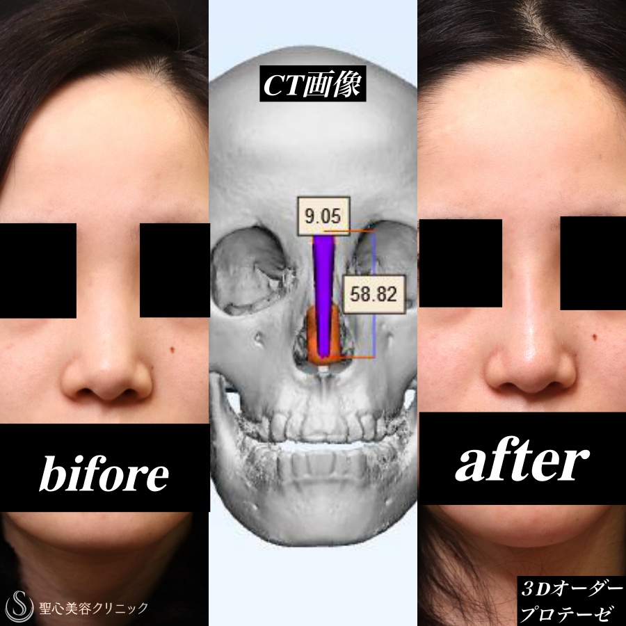 【10代女性・鼻筋をスッキリと】鼻３Dプロテーゼ＋耳介軟骨（1ヶ月後） Before 