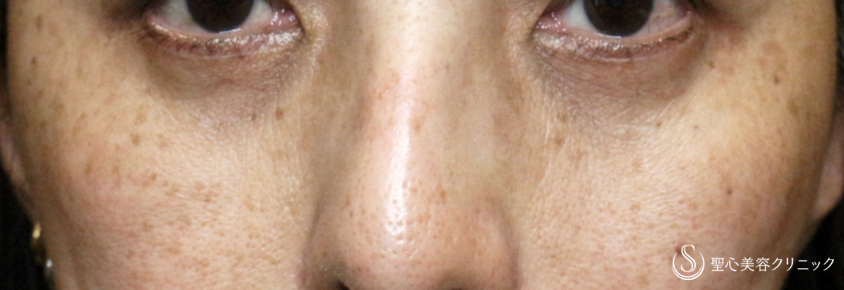 【50代女性・目の下のくま＆タルミ】ハムラ法+α＆プレミアムPRP皮膚再生療法（3年後） After 