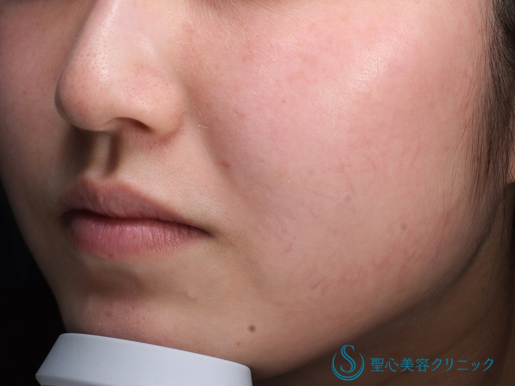 【20代女性・潤いのある肌に】ジュビダームボライト（2ヶ月後） Before 