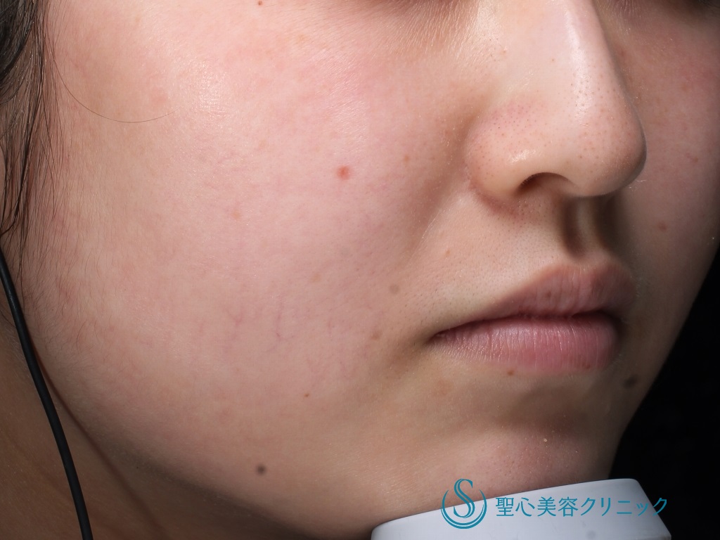 【20代女性・潤いのある肌に】ジュビダームボライト（2ヶ月後） Before 