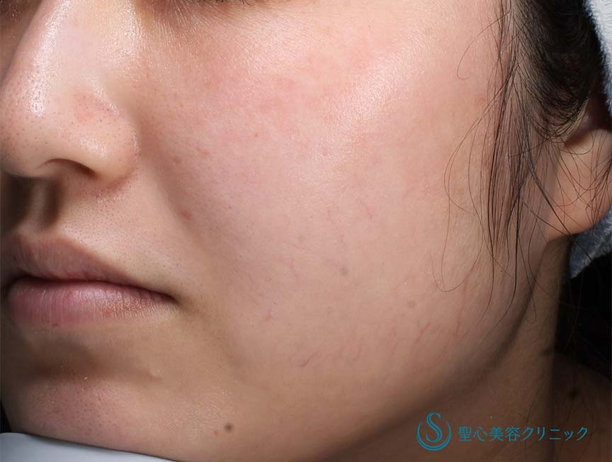 【20代女性・潤いのある肌に】ジュビダームボライト（2ヶ月後） After 