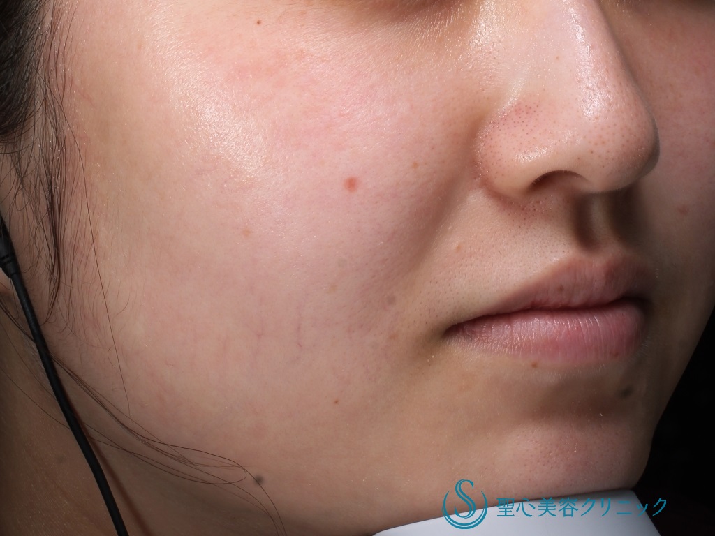 【20代女性・潤いのある肌に】ジュビダームボライト（2ヶ月後） After 