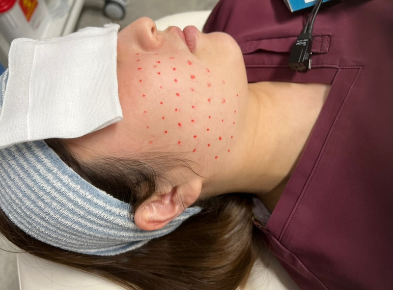 【20代女性・潤いのある肌に】ジュビダームボライト（2ヶ月後） Before 