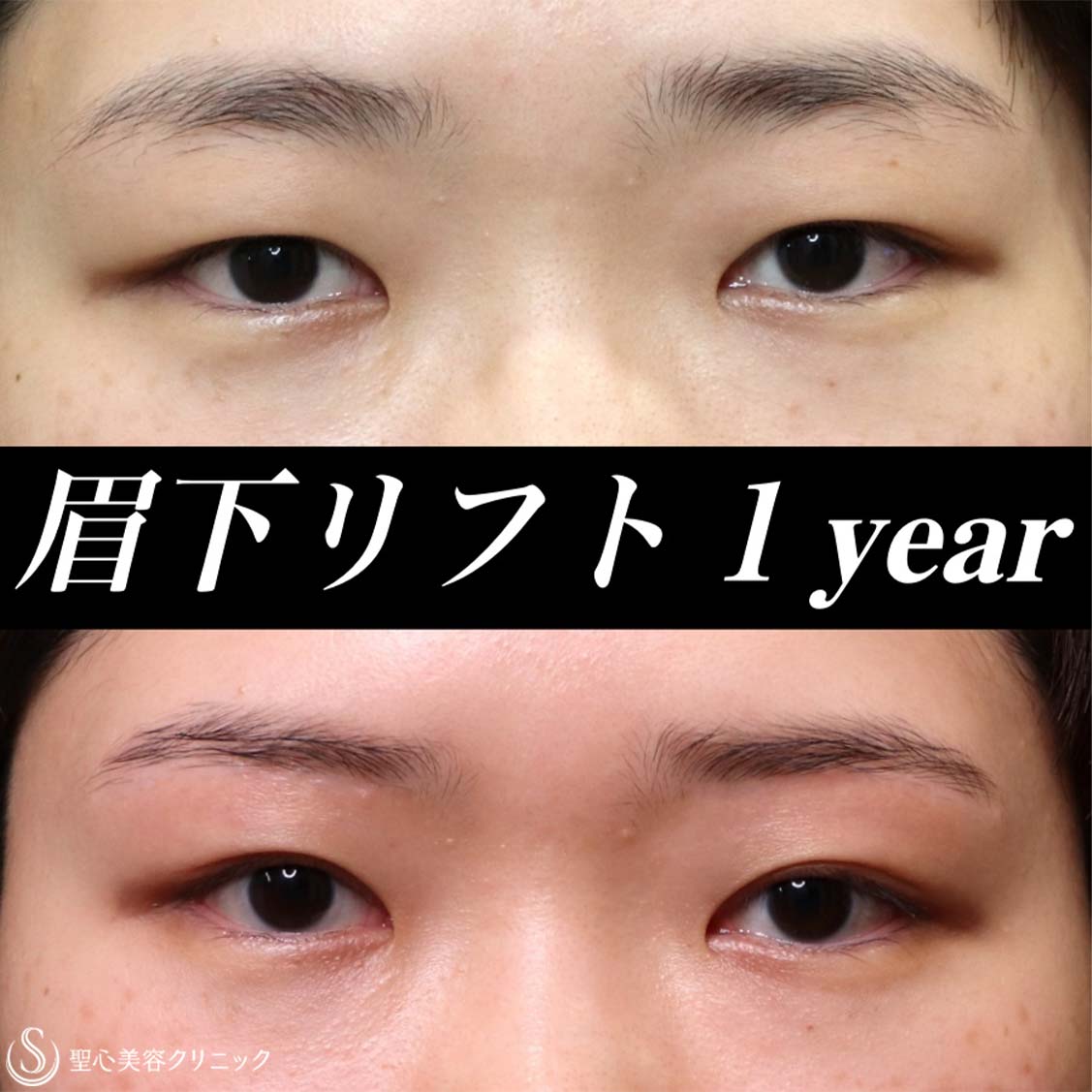 【20代女性・瞼の重みを改善】眉下リフト（1年後） Before 